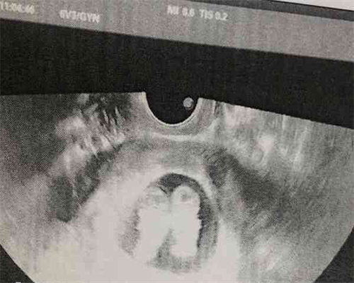 坤和代孕最低价格,2026最新试管双胞胎总套流程解析，附试管*双胞胎条件指南